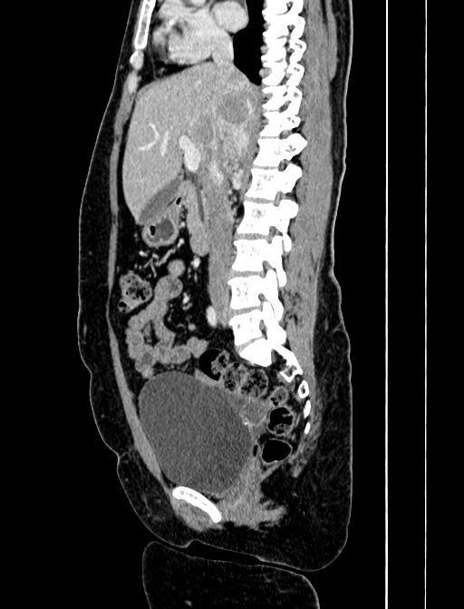 Adrenocortical carcinoma (Radiopaedia 87281-103569 Sagittal C+ portal venous phase 131).jpg