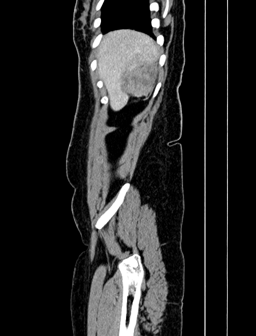 Adrenocortical carcinoma (Radiopaedia 87281-103569 Sagittal C+ portal venous phase 16).jpg