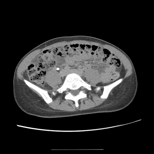 Adult polycystic kidney disease (Radiopaedia 48845-53876 Axial renal excretory phase 61).jpg