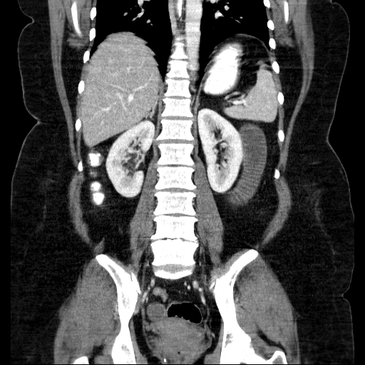 File:Afferent loop syndrome - secondary to incarcerated trocar site hernia (Radiopaedia 82959-97305 Coronal C+ portal venous phase 100).jpg