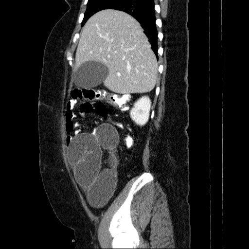 File:Afferent loop syndrome - secondary to incarcerated trocar site hernia (Radiopaedia 82959-97305 Sagittal C+ portal venous phase 118).jpg