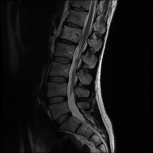 File:Aggressive vertebral hemangioma with pathological fracture (Radiopaedia 69528-79411 Sagittal T2 5).jpg