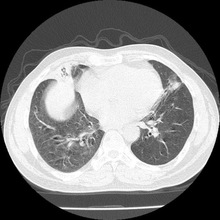Airway foreign body in adult (Radiopaedia 85907-101779 Axial lung window 122).jpg