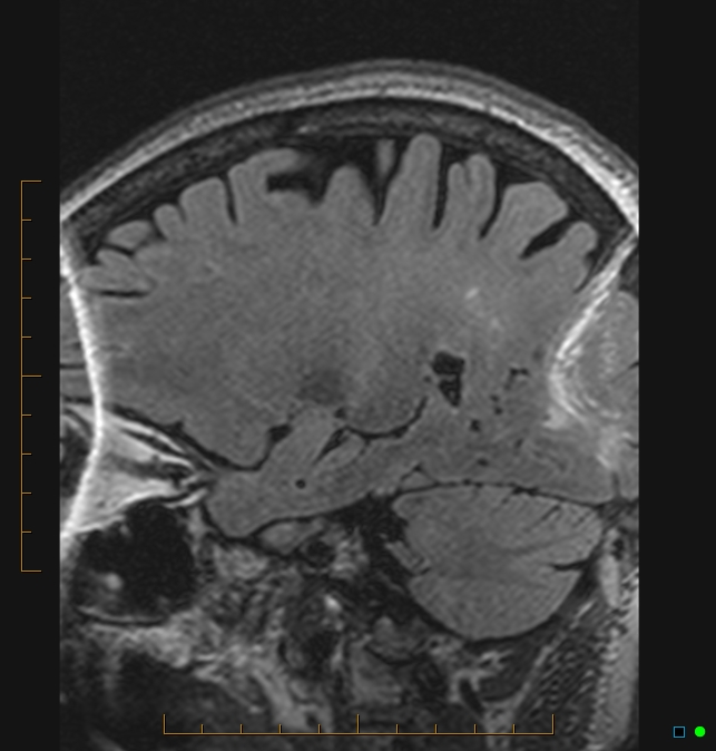 Aliasing artifact causing a spurious cerebellar lesion (Radiopaedia 48783-53810 Sagittal FLAIR 82).jpg