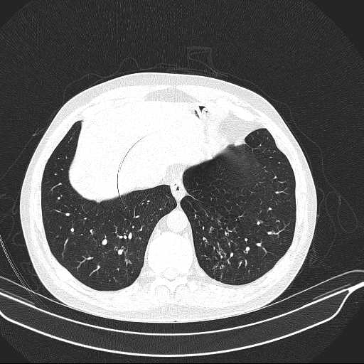 File:Allergic bronchopulmonary aspergillosis (Radiopaedia 21386-21320 Axial lung window 32).jpg