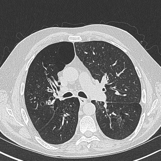 Allergic bronchopulmonary aspergillosis (Radiopaedia 44760-48571 Axial lung window 28).png