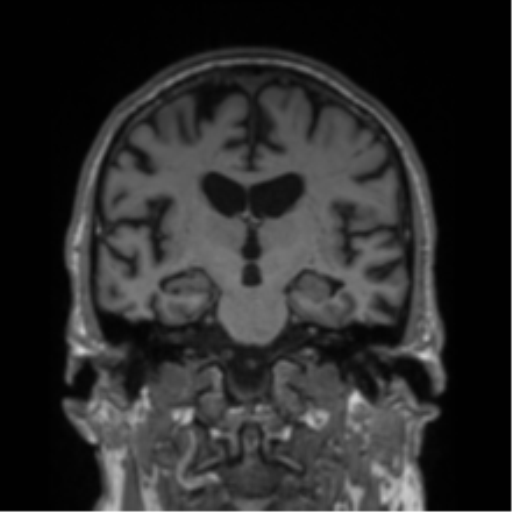 Alzheimer's disease- with Gerstmann syndrome and dressing apraxia (Radiopaedia 54882-61150 Coronal T1 45).png