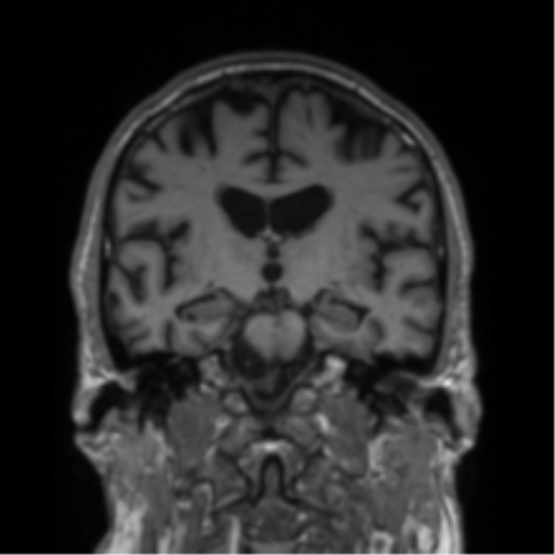 Alzheimer's disease- with Gerstmann syndrome and dressing apraxia (Radiopaedia 54882-61150 Coronal T1 47).png
