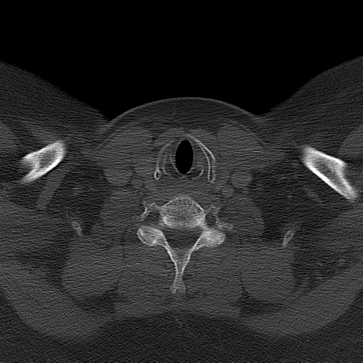 File:Ameloblastoma (Radiopaedia 38520-40623 Axial bone window 59).png