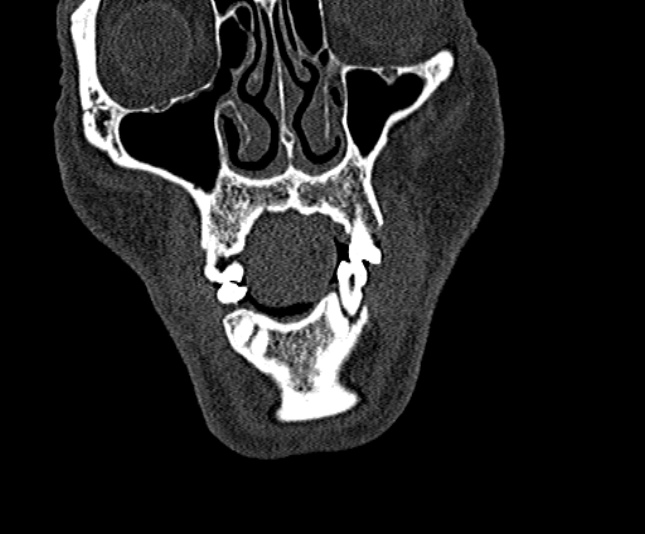 Ameloblastoma (Radiopaedia 51921-57766 Coronal bone window 38).jpg