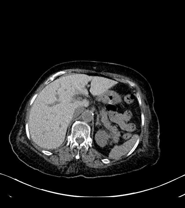 Amiodarone deposition in the liver (Radiopaedia 77587-89780 Axial non-contrast 83).jpg