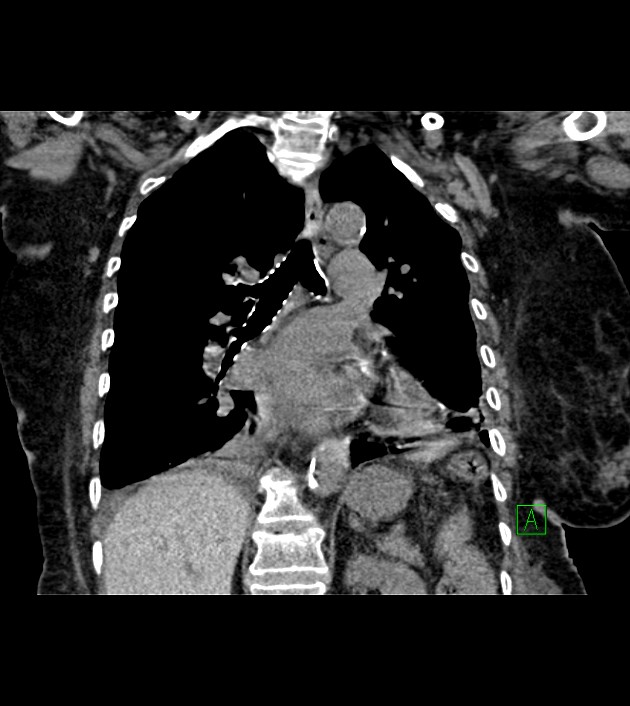 Amiodarone deposition in the liver (Radiopaedia 77587-89780 Coronal non-contrast 46).jpg