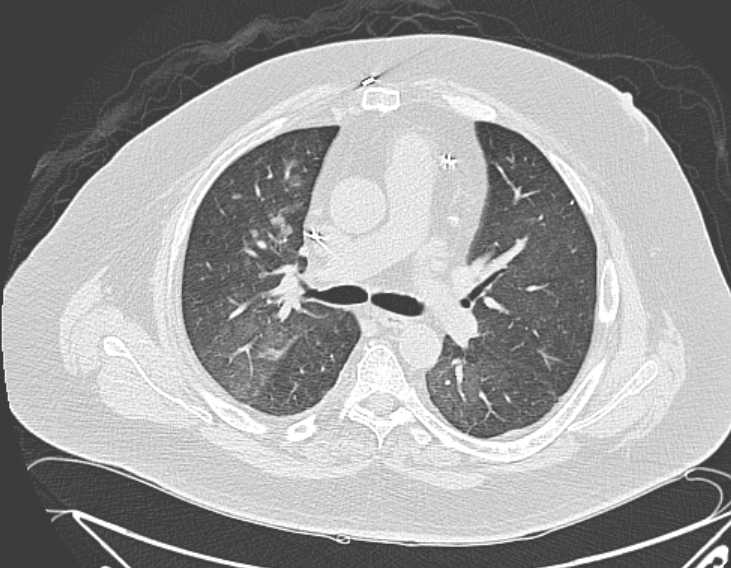 Amiodarone lung (Radiopaedia 62514-70769 Axial lung window 38).jpg