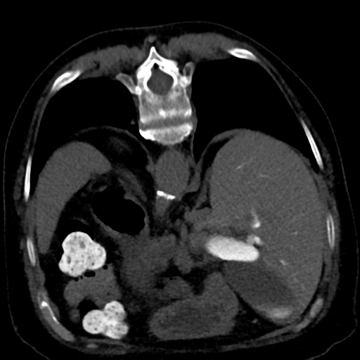 Ampullary adenocarcinoma (Radiopaedia 34013-35241 C 30).png
