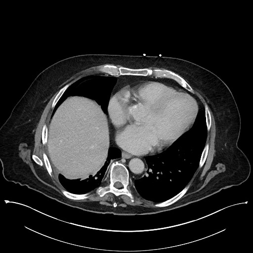Ampullary adenocarcinoma (Radiopaedia 59373-66737 A 17).jpg