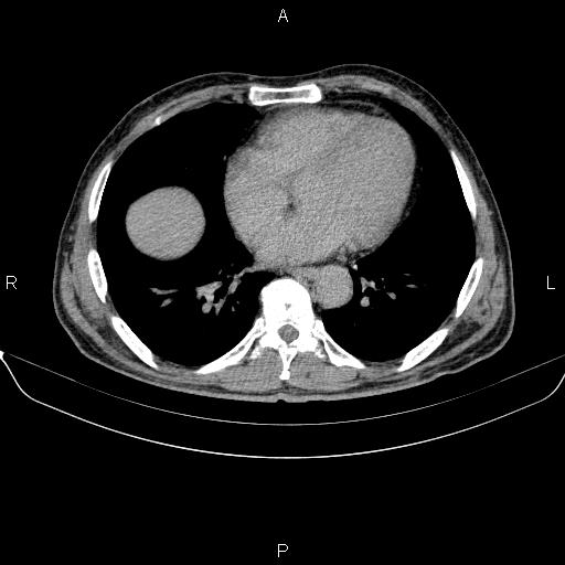 Ampullary adenocarcinoma (Radiopaedia 86093-102032 Axial C+ delayed 2).jpg