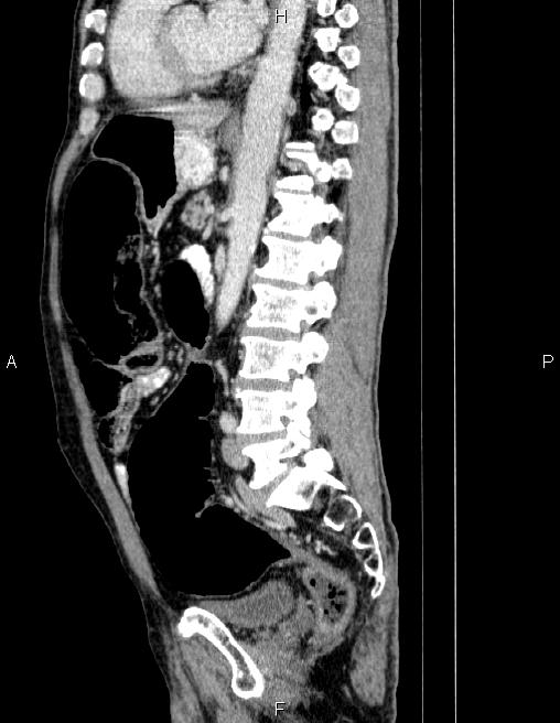 Ampullary adenocarcinoma (Radiopaedia 86093-102032 D 56).jpg