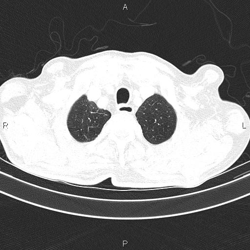 Ampullary adenocarcinoma (Radiopaedia 86093-102033 Axial lung window 16).jpg