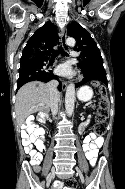 Ampullary adenocarcinoma (Radiopaedia 86093-102033 D 34).jpg