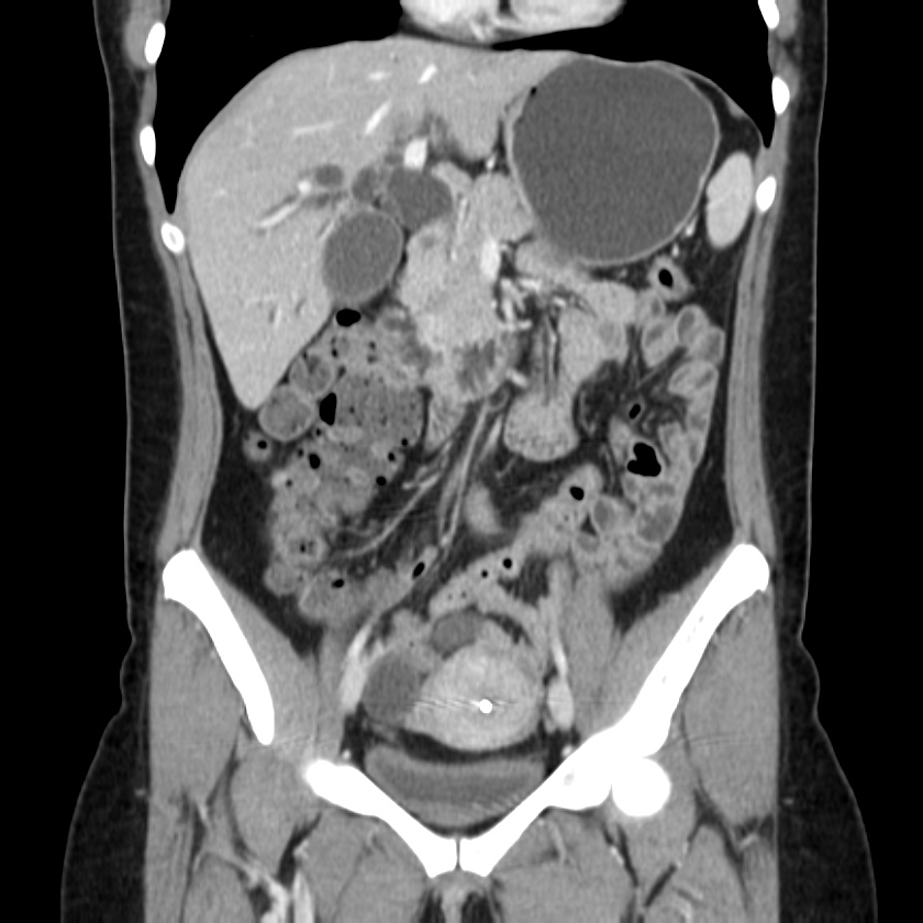 Ampullary tumor (Radiopaedia 22787-22816 E 25).jpg