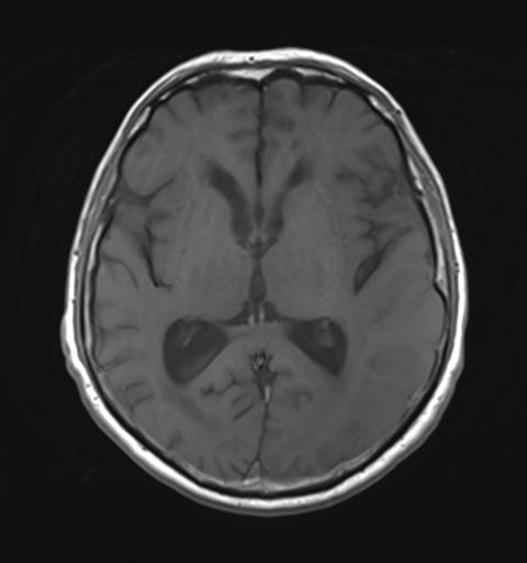 File:Amyloid angiopathy with inflammation (Radiopaedia 30360-31002 Axial T1 17).jpg