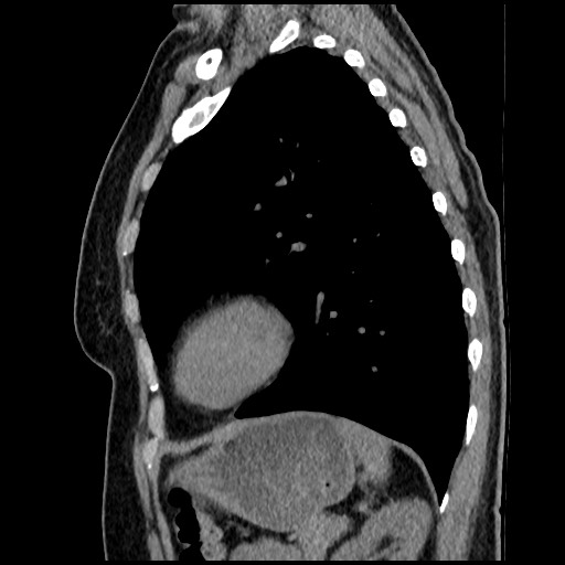 Amyloidosis - bronchial and diffuse nodular pulmonary involvement (Radiopaedia 60156-67744 E 40).jpg