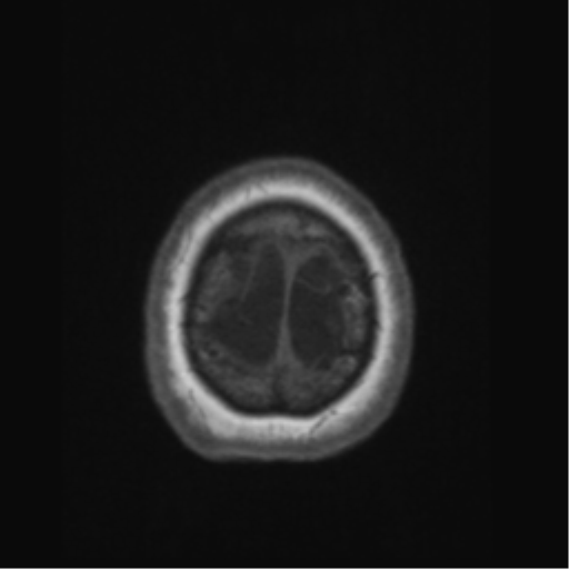 Anaplastic astrocytoma IDH wild-type (pseudoprogression) (Radiopaedia 42209-45276 Axial T1 142).png