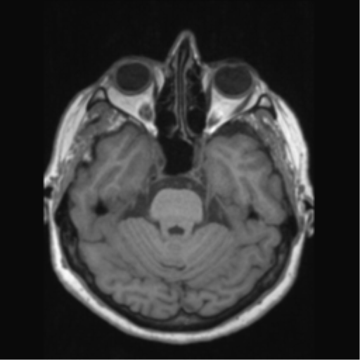 Anaplastic astrocytoma IDH wild-type (pseudoprogression) (Radiopaedia 42209-45276 Axial T1 53).png