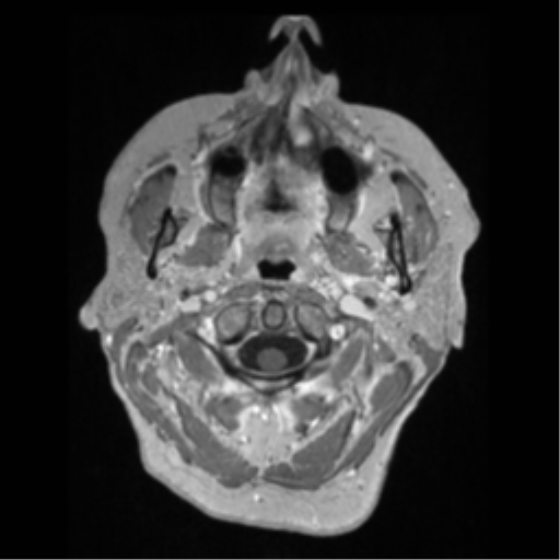 File:Anaplastic astrocytoma IDH wild-type (pseudoprogression) (Radiopaedia 42209-45276 Axial T1 C+ 7).png