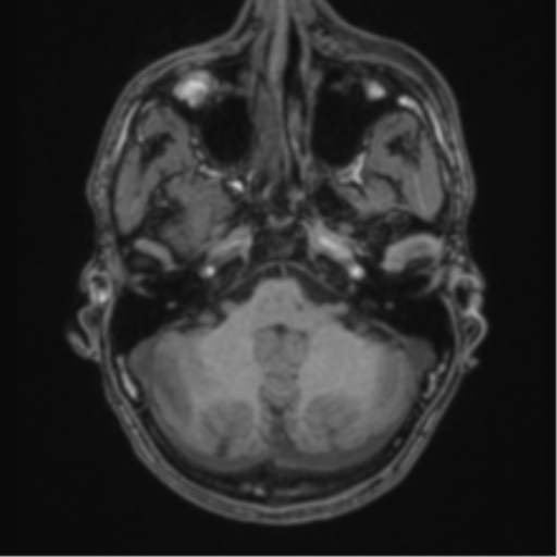 Anaplastic oligodendroglioma with skull fracture (Radiopaedia 74831-85845 Axial T1 10).png