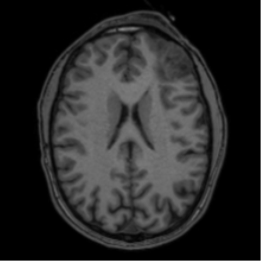 Anaplastic oligodendroglioma with skull fracture (Radiopaedia 74831-85845 Axial T1 39).png