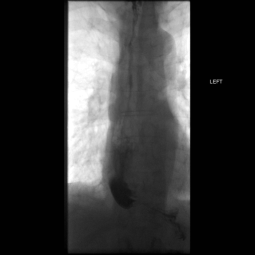 File:Anastomotic stricture post Ivor Lewis esophagectomy (Radiopaedia 47937-52715 B 53).png