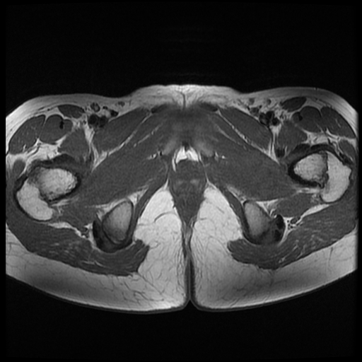File:Androgen insensitivity syndrome (Radiopaedia 38585-40727 Axial T1 24).jpg
