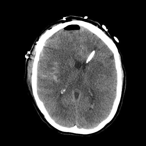 Aneursym related subarachnoid hemorrhage with hydrocephalus (Radiopaedia 45105-49085 Axial non-contrast 28).jpg