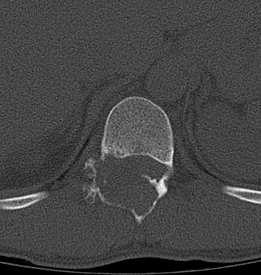 Aneurysmal bone cyst T11 (Radiopaedia 29294-29721 Axial bone window 44).jpg