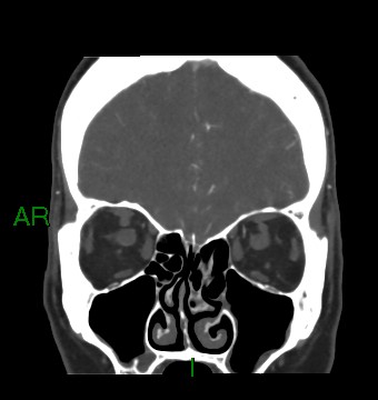 File:Aneurysmal subarachnoid hemorrhage with intra-axial extension (Radiopaedia 84371-99732 C 79).jpg