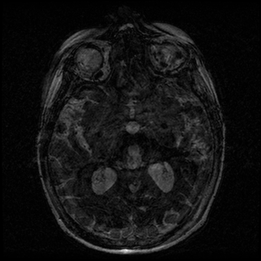 Angioinvasive aspergillosis in the pituitary fossa (Radiopaedia 39676-42010 Ax 3D FIESTA VOLUME 99).png