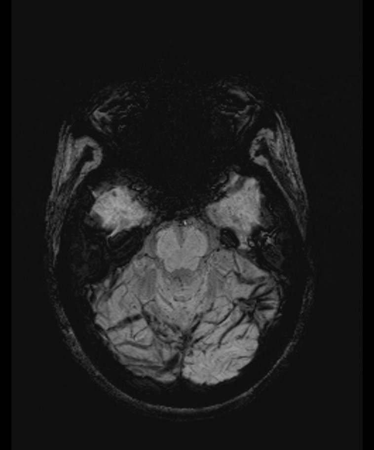 Angiomatous meningioma (Radiopaedia 79459-92579 E 19).jpg