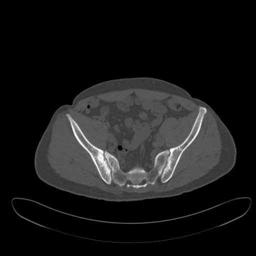 Ankylosing spondylitis (Radiopaedia 52728-58645 Axial bone window 38).jpg