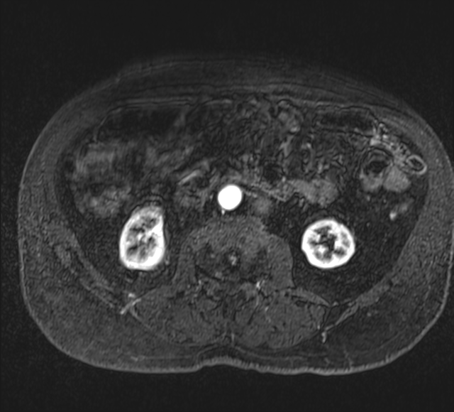 Annular pancreas (Radiopaedia 38292-40320 Axial T1 C+ fat sat 64).png