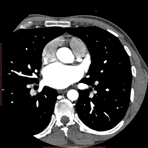 Anomalous left coronary artery from the pulmonary artery (ALCAPA) (Radiopaedia 70148-80181 A 101).jpg