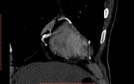 Anomalous left coronary artery from the pulmonary artery (ALCAPA) (Radiopaedia 70148-80181 B 54).jpg