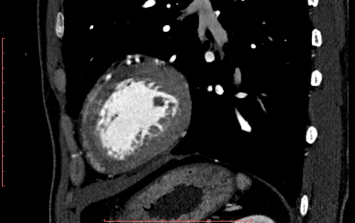 File:Anomalous left coronary artery from the pulmonary artery (ALCAPA) (Radiopaedia 70148-80181 C 205).jpg