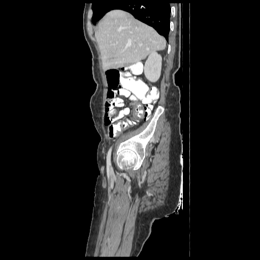 Anorectal carcinoma (Radiopaedia 44413-48064 C 19).jpg