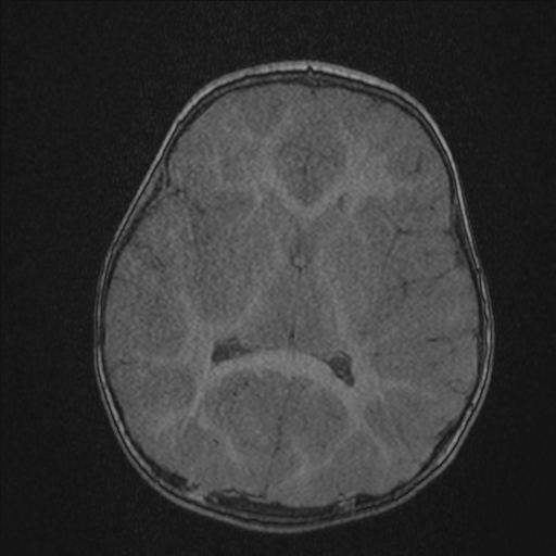 Anoxic brain injury (Radiopaedia 79165-92139 Axial MRA 134).jpg