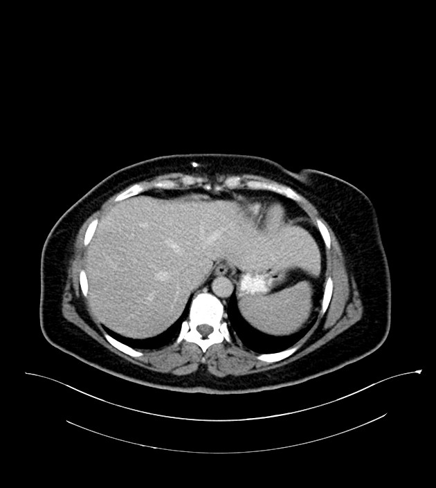 Anterior abdominal wall CSF pseudocyst (CSFoma) (Radiopaedia 79453-92571 A 17).jpg