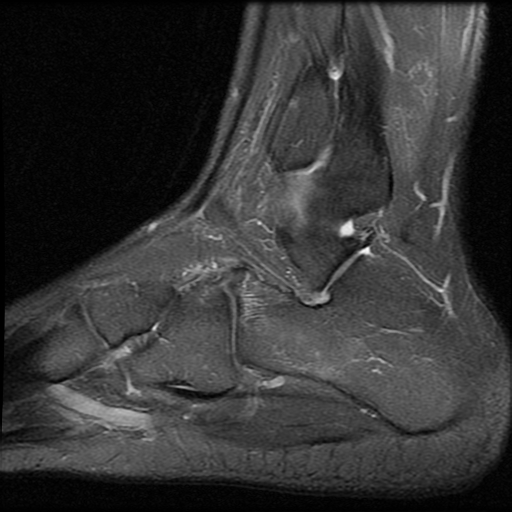 File:Anterior calcaneal process fracture (Radiopaedia 74654-85611 Sagittal PD fat sat 15).jpg