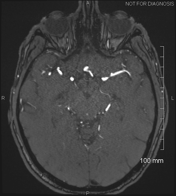 Anterior cerebral artery aneurysm (Radiopaedia 80683-94127 Axial MRA 102).jpg