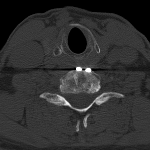 Anterior cervical postdiscectomy arthrodesis (Radiopaedia 32678-33646 Axial bone window 54).jpg