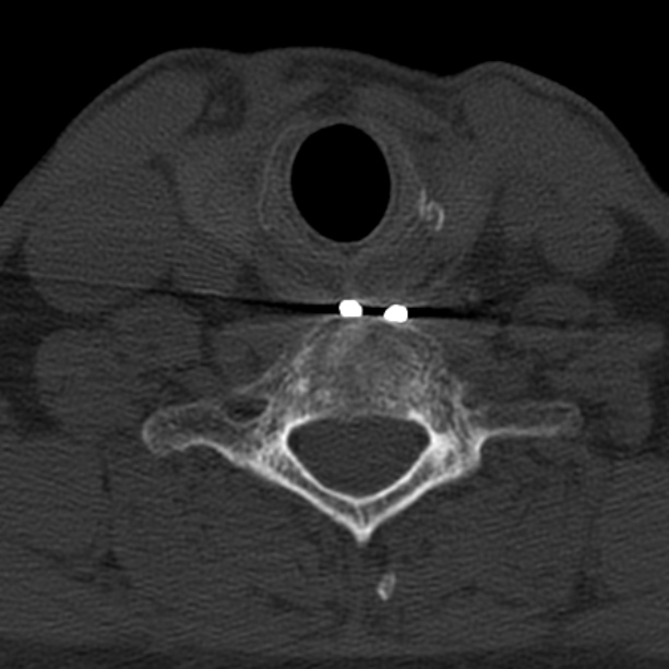 Anterior cervical postdiscectomy arthrodesis (Radiopaedia 32678-33646 Axial bone window 57).jpg